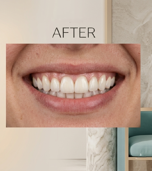 After smile makeover at Saraswati Dental Clinic — bright, perfectly aligned smile after cosmetic treatment